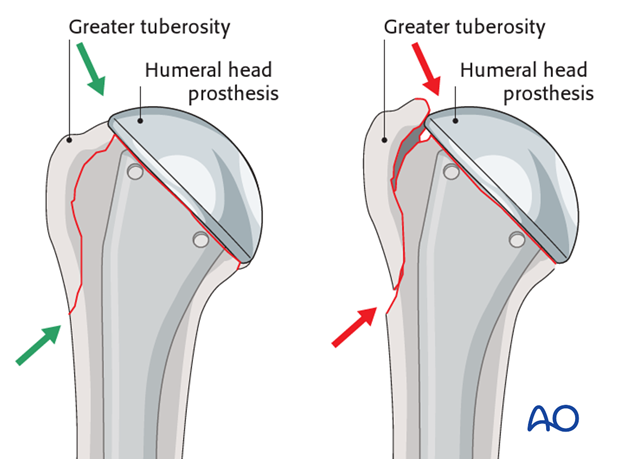 The inferior spike of the greater tuberosity should fit snugly into the fracture gap. This would be revealed by visual control.