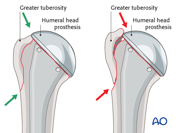 The rotator cable extends from lesser tubercle of humerus to greater