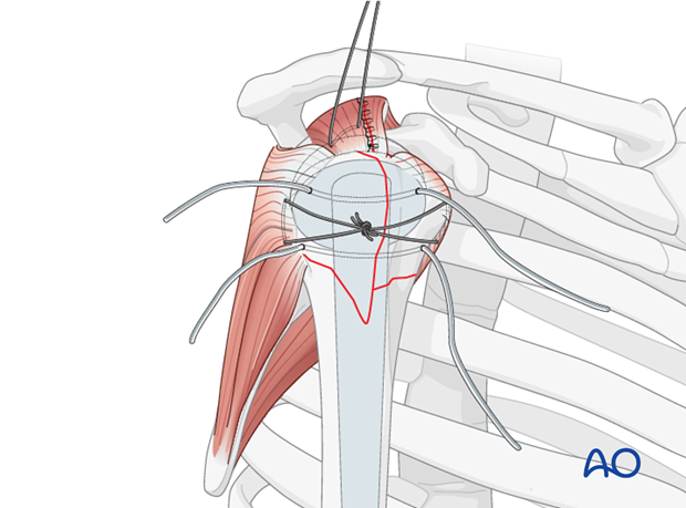 Close the supraspinatus split with a running suture.