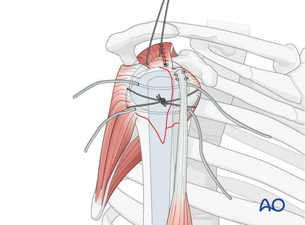 Place the bicipital tendon into the bicipital groove and preliminarily fix it with sutures. 