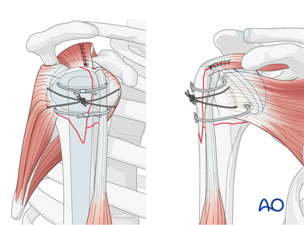 Tighten the two tuberosity cables and fix them appropriately over the bicipital tendon