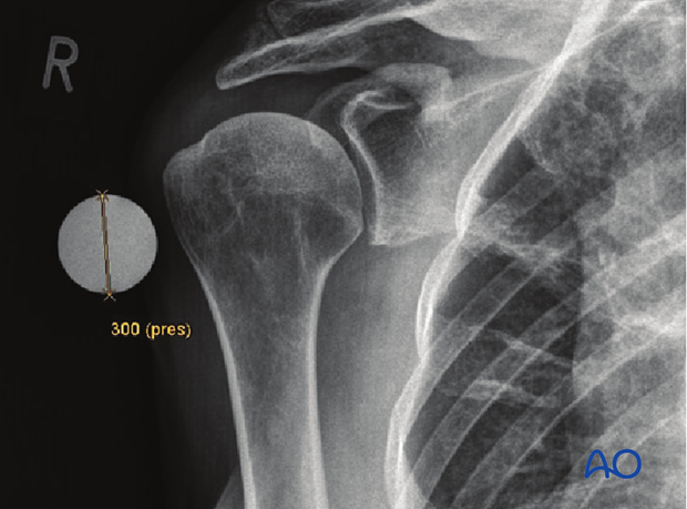 If an x-ray is used to determine the size of the humeral head use a marker ball to compensate for radiological magnification.