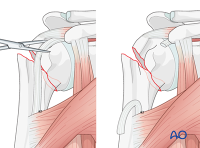 Reverse arthroplasty for Extraarticular 2-part, surgical neck, impaction