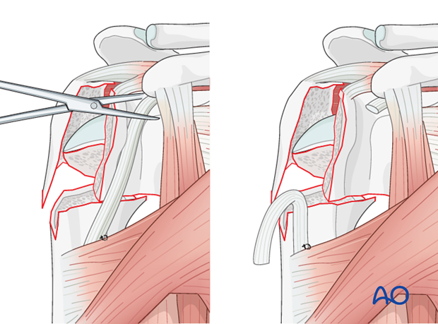 reverse arthroplasty