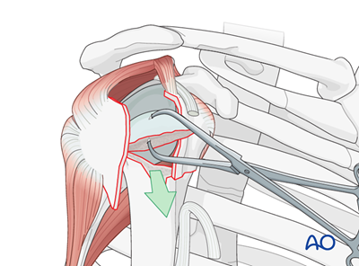 Reverse arthroplasty for Extraarticular 2-part, surgical neck, impaction