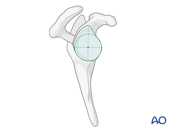 11_O95_i240 reverse arthroplasty