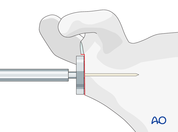 11_O95_i260 reverse arthroplasty