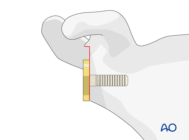 reverse arthroplasty