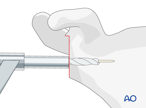 reverse arthroplasty