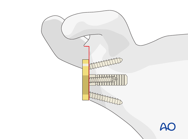 11_O95_i300 reverse arthroplasty