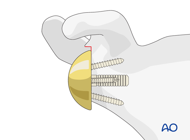 reverse arthroplasty