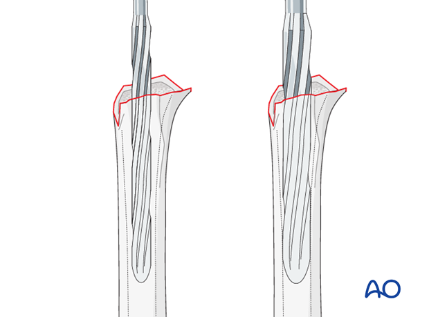 11_O95_i340 reverse arthroplasty