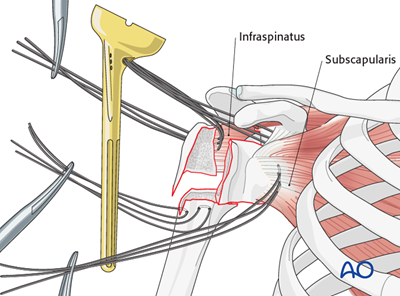 Reverse Arthroplasty For Extraarticular 2-part, Surgical Neck, Impaction