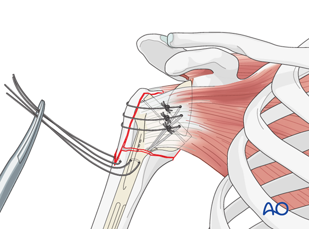 11_O95_i500 reverse arthroplasty