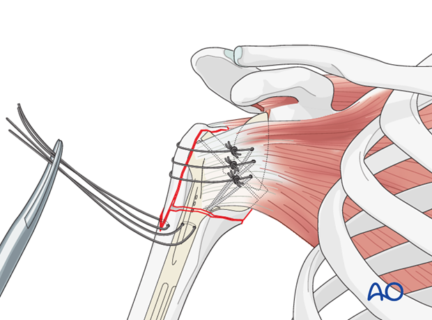 reverse arthroplasty