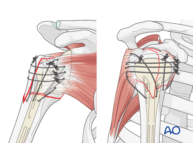 extraarticular 3 part surgical neck and tuberosity dislocation