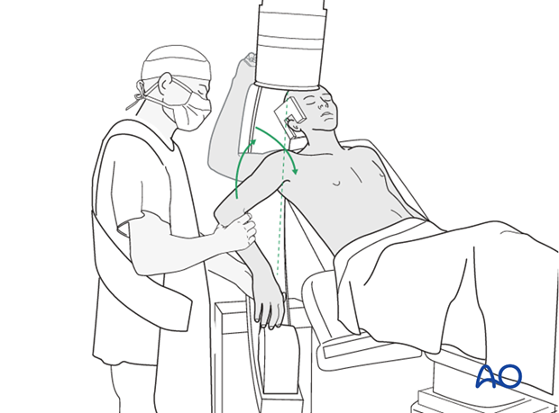 11_Pr01_i140 In the beach chair position, the C-arm must be directed appropriately for orthogonal views.