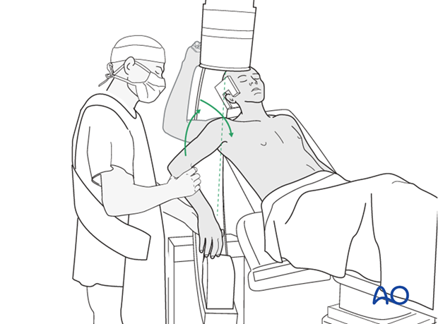 In the beach chair position, the C-arm must be directed appropriately for orthogonal views. 