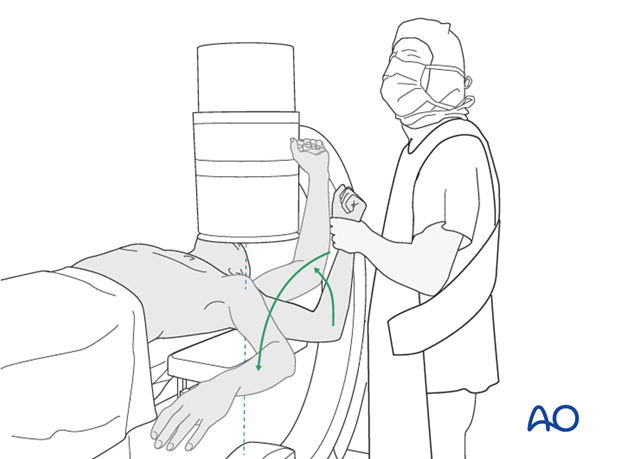 11_Pr01_i160 Carefully check for correct reduction and fixation (including proper implant position and length) at various arm positions.