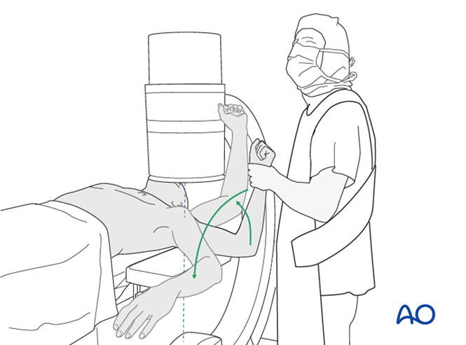 ORIF - Plate fixation for 4-Part, marked displacement, intact articular ...
