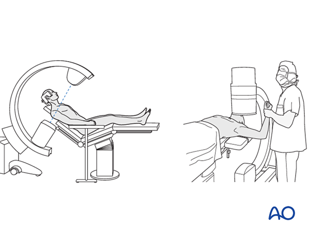 Patient in beach chair and supine position with corresponding C-arm orientation