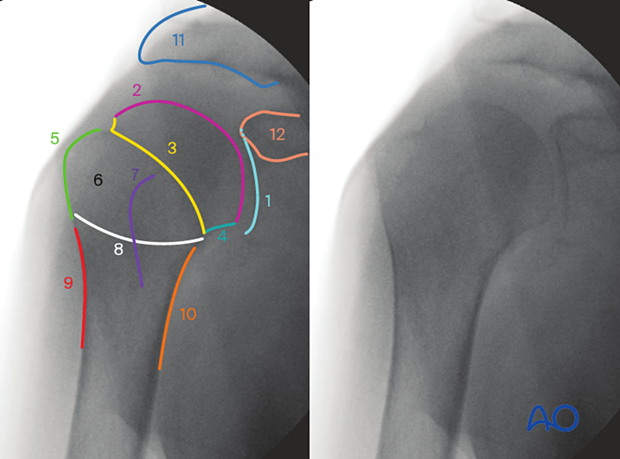 Fluoroscopic landmarks in the AP view of the shoulder