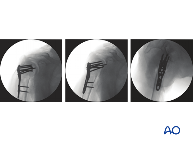 Dynamic image intensification of a proximal humeral fracture with plate fixation