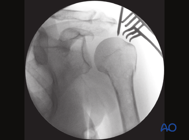 This AP view shows the guide wire for nail insertion into the proximal humerus pointing slightly lateral to the apex of the head for a bent nail.