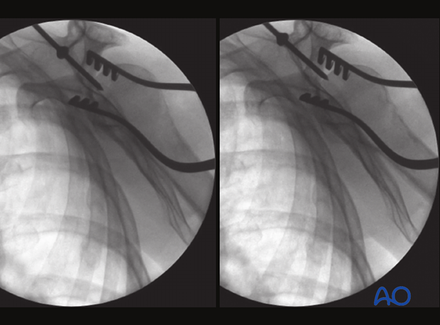 This scapula-Y view shows the guide wire for nail insertion into the proximal humerus pointing slightly lateral to the apex of the head for a bent nail.