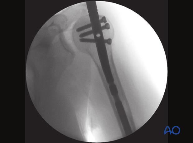 AP view of a nail inserted and fixed with screws to the humeral head with the insertion handle still in place