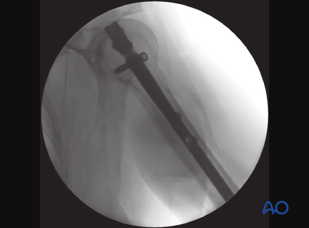 Lateral view of a nail inserted and fixed with screws to the humeral head with the insertion handle still in place