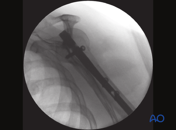 Scapular-Y view of a nail inserted and fixed with screws to the humeral head with the insertion handle still in place