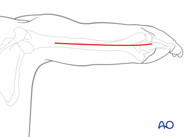 Distal posterior approach