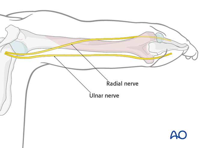 Posterior triceps-sparing approach (triceps-on) to the humeral shaft