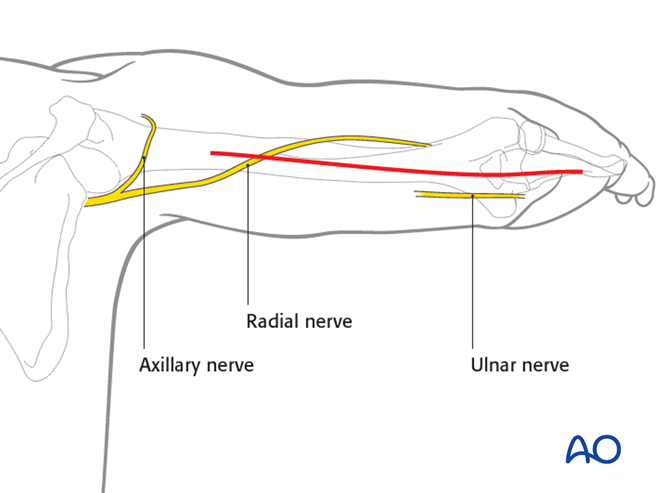 Posterior triceps-sparing approach (triceps-on) to the humeral shaft