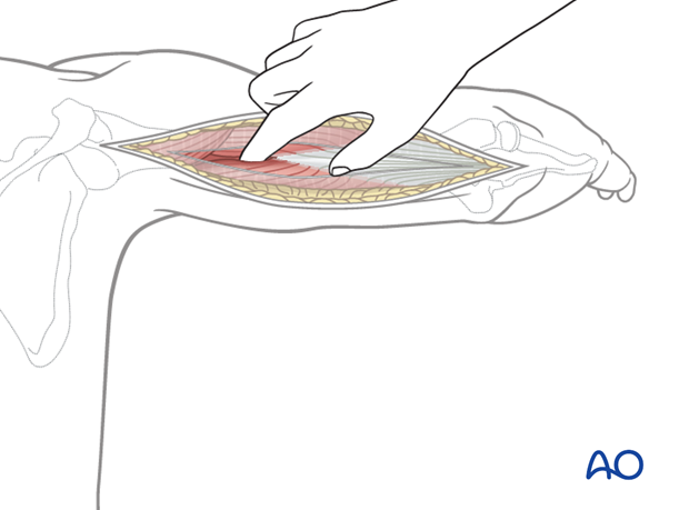 By palpation with a finger, identify the interval between the lateral and long heads of the triceps.