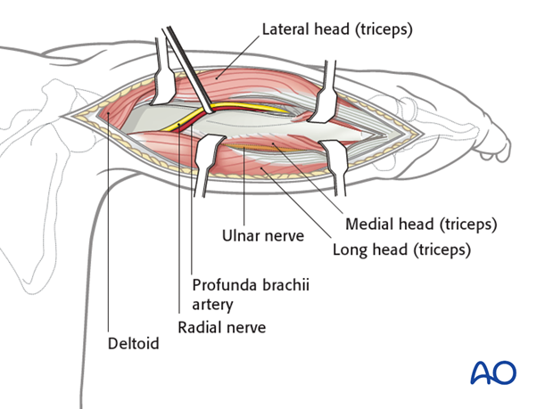 Release the medial head of the triceps from the humerus proximally, and incise it distally, in line with the humeral shaft.