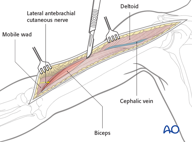 Anterolateral approach to the humerus (after Henry)