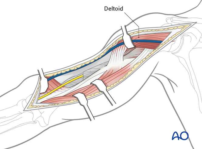 Anterolateral approach to the humerus (after Henry)