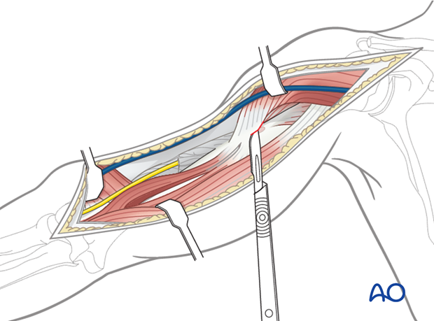 Partially release the deltoid insertion anteriorly, if necessary, and retract laterally to access the proximal humerus.