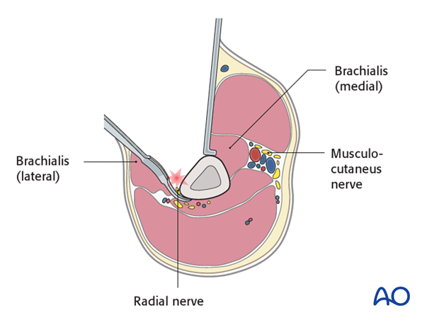 Pitfall: injury of the radial nerve