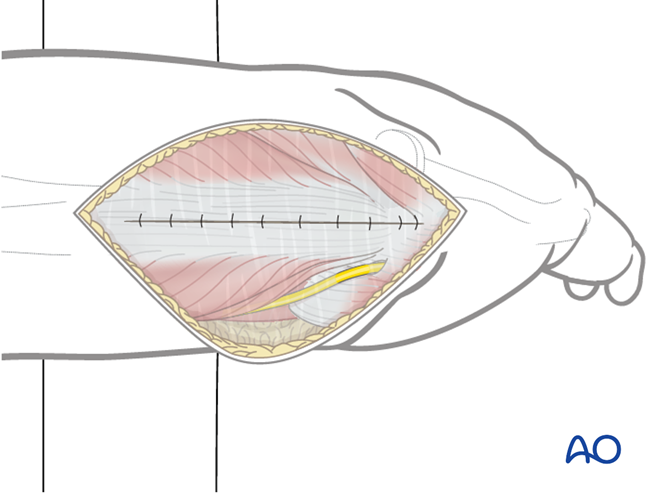 Retrograde nailing approach to the humeral