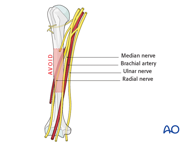 Safe zones in the humerus for percutaneous pins or screws