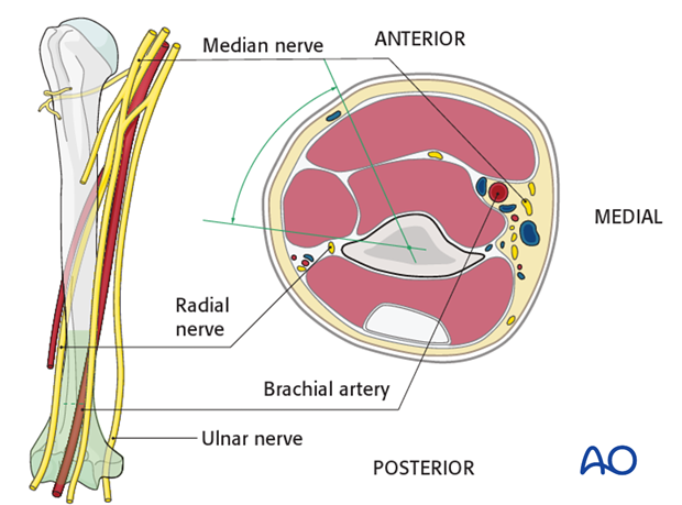 Consider placing the pin laterally within the dangerous zone of the radial nerve.
