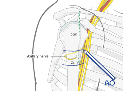 Safe zones in the humerus for percutaneous pins or screws