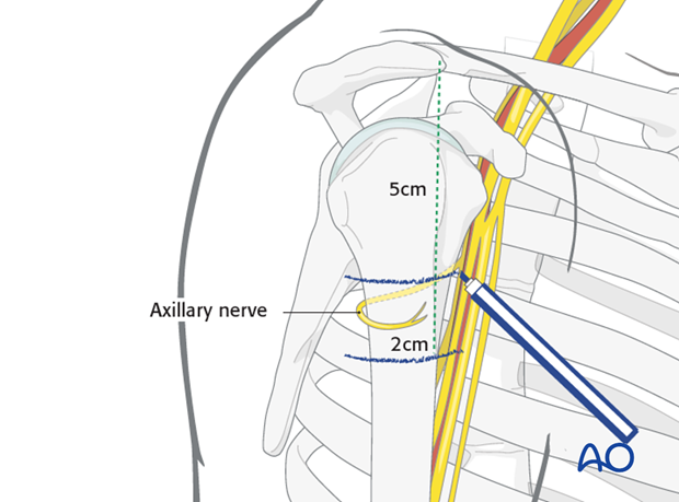 The axillary nerve runs dorsolaterally around the humeral metaphysis, about 5-7 cm below the acromion.