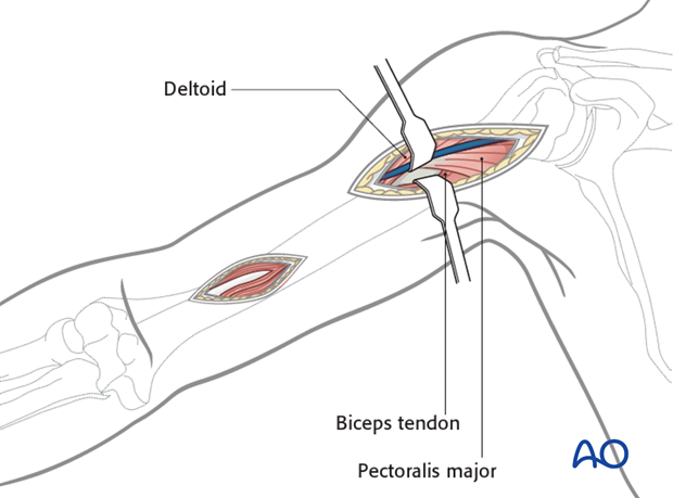 Proximal portal (deltobicipital)