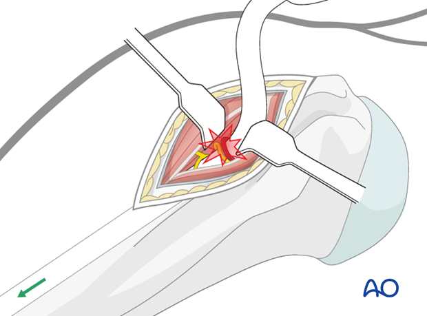 Take great care not to stretch or injure the axillary nerve and its accompanying vessels.