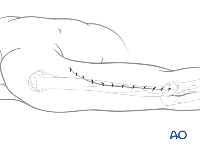 Gerwin Approach Lateral approach to the humeral shaft