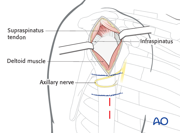 mio transdeltoid lateral approach